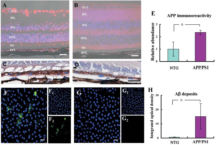 Amyloid Beta Deposition Related Retinal Pigment Epithelium Cell Impairment And Subretinal Microglia Activation In Aged Appsweps1 Transgenic Mice